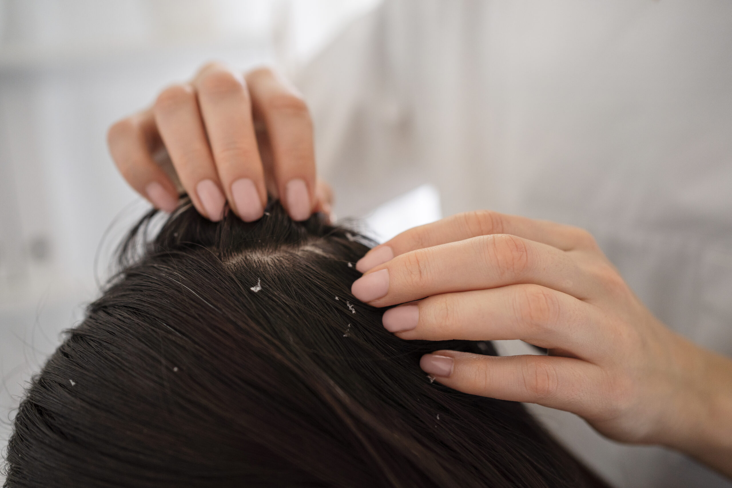 cara menumbuhkan rambut botak pada wanita